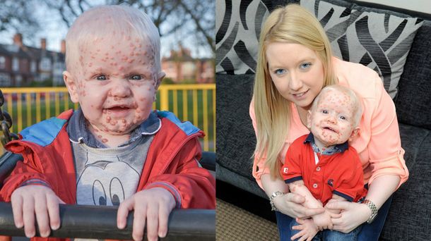 Nadie se quiere acercar a este bebé por la extraña enfermedad que padece