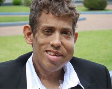 Murió el único argentino con la enfermedad del hombre elefante