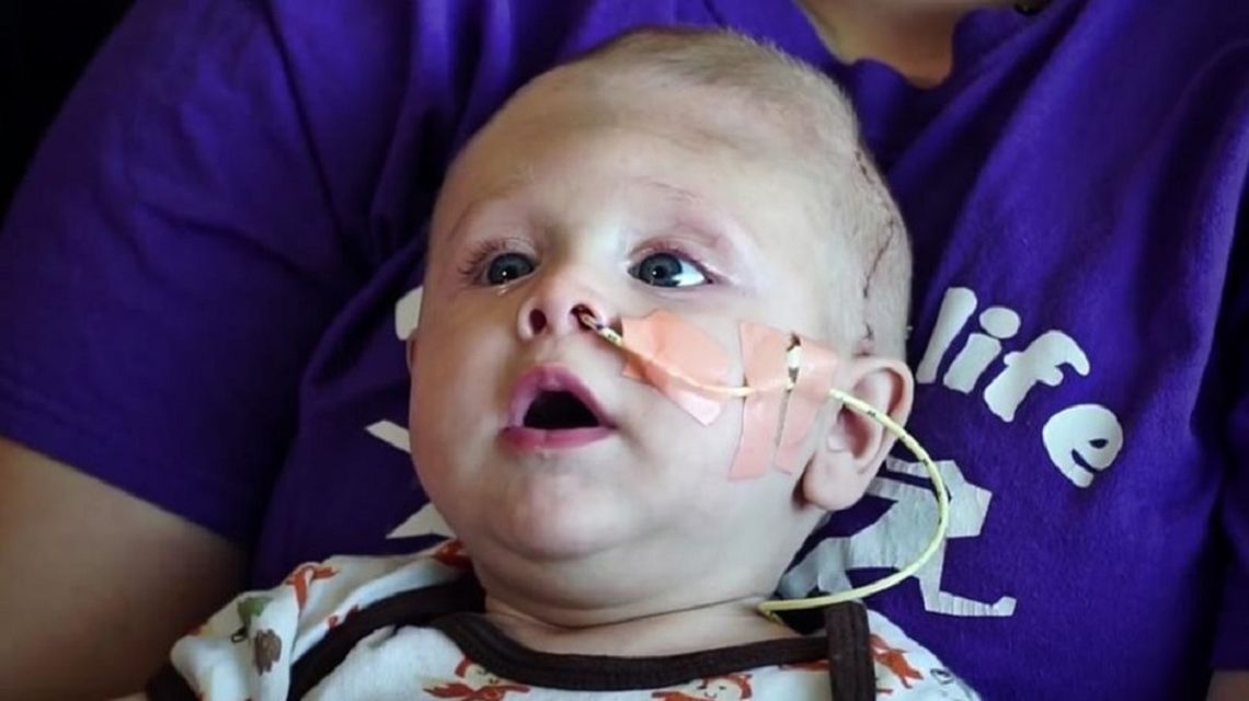 Bebé Nació Con El Cerebro Fuera De La Cabeza Fue Operado Y Se Recupera 8618