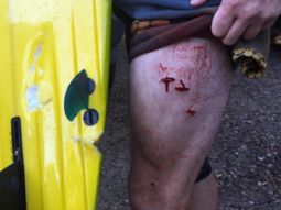 La mordida del tiburón en el muslo del surfista La mordida del tiburón en el muslo del surfista