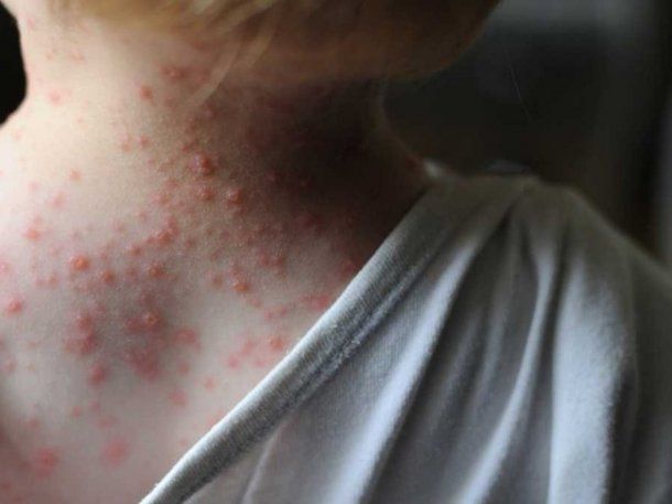 Alerta mundial por la viruela del mono