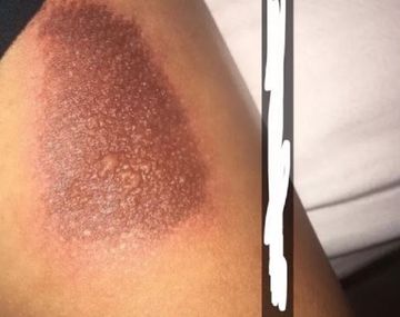 Reportan que las fundas con brillantina y líquido queman la piel de usuarios