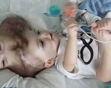 Separaron en Nueva York a dos siameses unidos por la cabeza