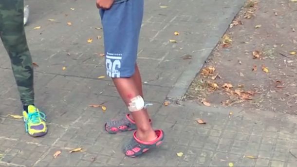 La Plata: un perro pitbull atacó a un nene de 10 años y sigue suelto en el barrio