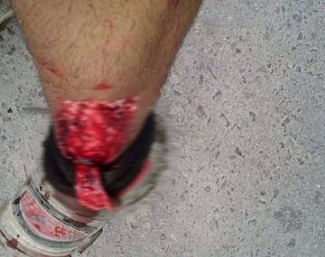 Un pitbull atacó a un recolector de basura en La Plata