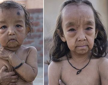 Dos niños sufren la enfermedad de Benjamin Button