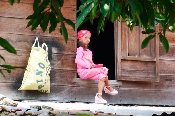 Tiene 18 años, pero una rara condición médica hace que su cuerpo tenga 144