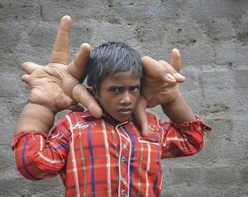 El caso de un niño con manos gigantes