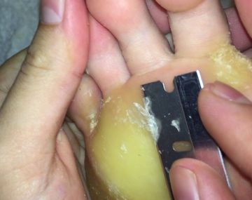 El callo interminable o Never Ending Callus