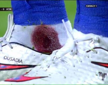 Mirá cómo le quedó el tobillo a un crack del Barça después de una patada