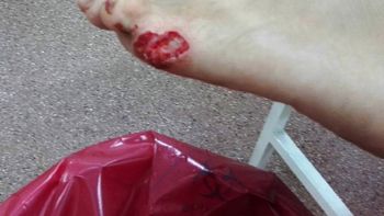 Un matrimonio afirma que fue mordido por pirañas en Misiones Un matrimonio afirma que fue mordido por pirañas en Misiones