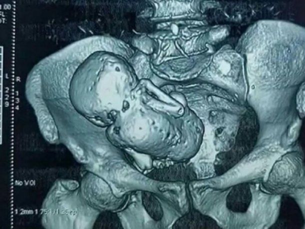 México: descubrieron un feto momificado en una mujer de 84 años