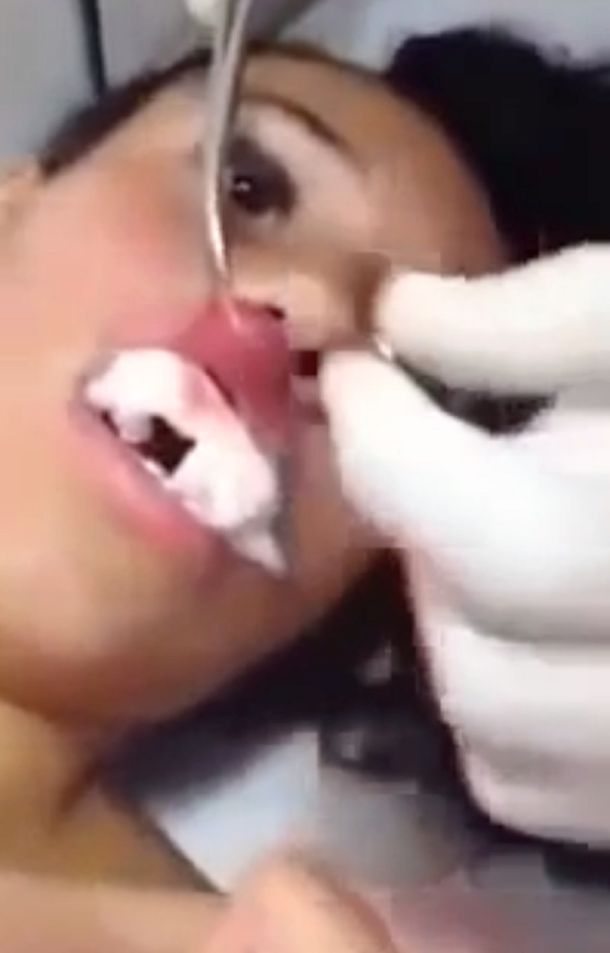 Insólito: sentía dolor en el labio y le sacaron un gusano