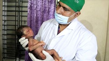 el extrano caso del bebe anciano: nacio cubierto por arrugas y pelo el extrano caso del bebe anciano: nacio cubierto por arrugas y pelo