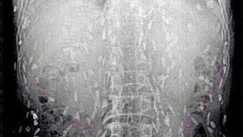 comio sushi en mal estado y se lleno de gusanos comio sushi en mal estado y se lleno de gusanos