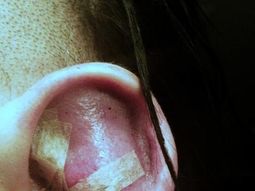 Así quedó la oreja de Marilyn Manson Así quedó la oreja de Marilyn Manson