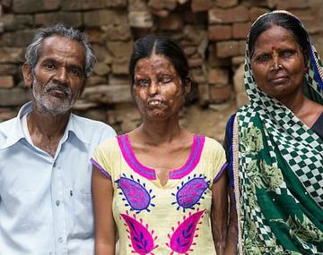 El hombre las roció con ácido a las dos mientras dormían