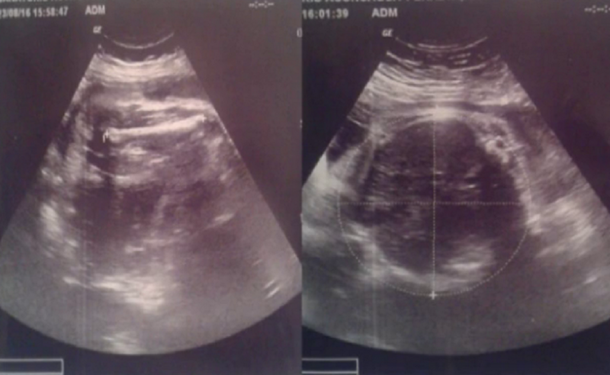 La madre asegura que en la ecografía se veían a dos bebés. Foto: canal 10.