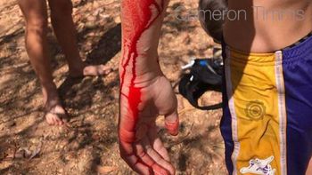 Un adolescente es atacado por un cocodrilo Un adolescente es atacado por un cocodrilo