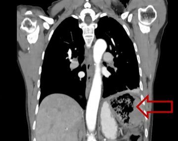 Insólito: una mujer vivió 20 años con una gasa en el intestino