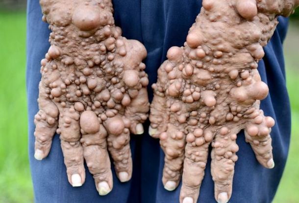 Conmoción por el desesperado pedido de ayuda del Hombre burbuja