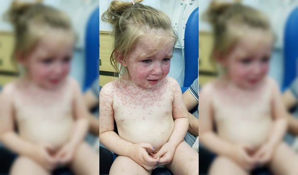 Le dijeron que su hija tenía varicela pero se había contagiado fiebre aftosa humana