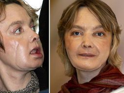 Isabelle Dinoire Isabelle Dinoire