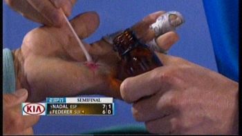 asi quedo la mano de nadal tras destrozar a federer asi quedo la mano de nadal tras destrozar a federer