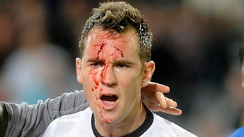 le dieron un planchazo en la cara pero el arbitro no lo cobro le dieron un planchazo en la cara pero el arbitro no lo cobro