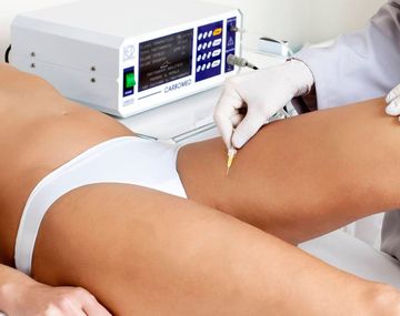 Entre Ríos: una mujer murió tras un tratamiento de carboxiterapia