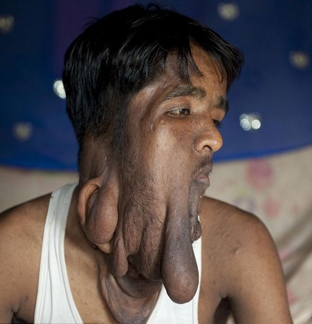 Logran rehabilitar al hombre elefante en la India