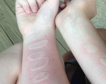 Así quedan las quemaduras en el &nbsp;cuerpo