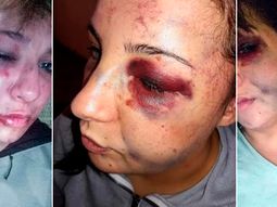 Brutal golpiza en La Plata: así quedó la joven que fue desfigurada por su ex