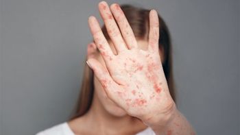 Sarampión. Sarampión.