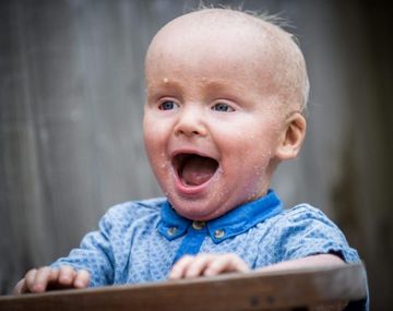 La extraña enfermedad que padece un bebé con la piel de escamas de pescado