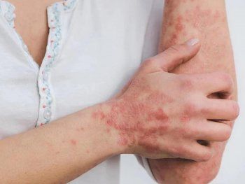 La OMS descarta que la viruela del mono se convierta en pandemia