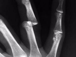 asi le quedo el dedo al arquero que quiere guillermo para boca asi le quedo el dedo al arquero que quiere guillermo para boca