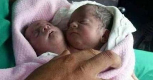 Nació un bebé con dos cabezas en Siria