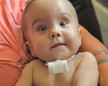 Un bebé sobrevive gracias a una impresora 3D