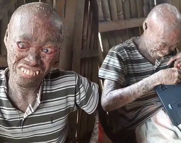 Reloj tiene 26 años y sufre esta condición desde los 12