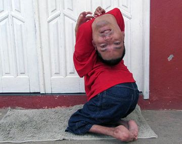 Conocé la conmovedora historia del hombre que nació con la cabeza para atrás