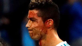 impresionante: real madrid mostro detalles de la profunda herida de cr7 impresionante: real madrid mostro detalles de la profunda herida de cr7