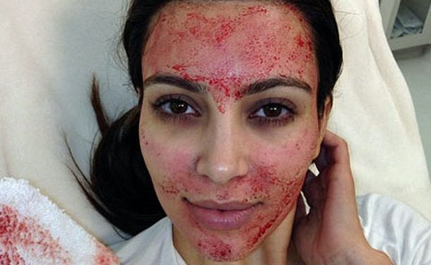 Vampiro facial: nuevo tratamiento de belleza sangriento