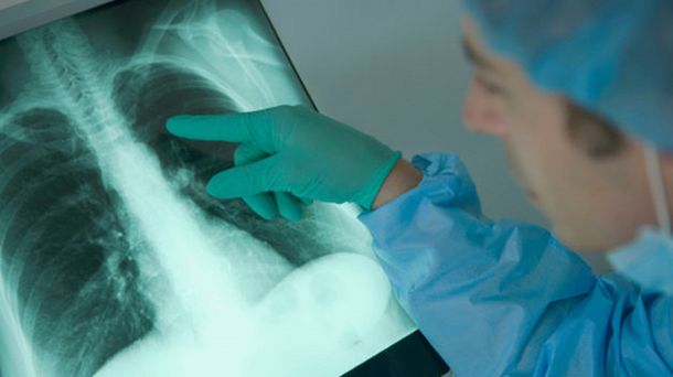 Francia: una mujer recibió los pulmones de una fumadora y murió de cáncer