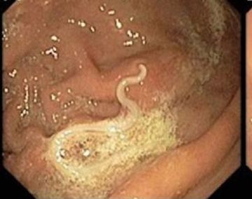 Las larvas del parásito Anisakis, adheridas al intestino