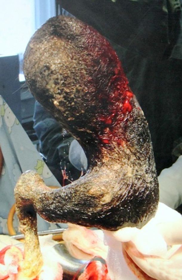 Le sacan a una adolescente una pelota de pelos de 4 kilos del estómago