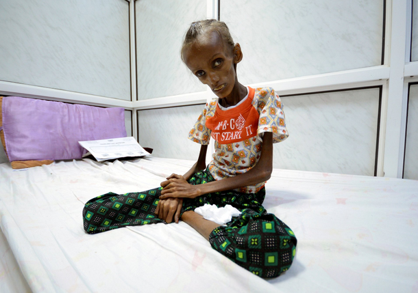 Saida Ahmad Baghili sufre desnutrición aguda con 18 años de edad