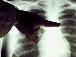 Cáncer de pulmón, de los más mortales