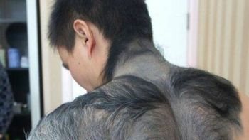 por un defecto genetico se convirtio en un hombre lobo por un defecto genetico se convirtio en un hombre lobo