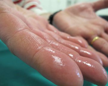 ¿Qué es la hiperhidrosis?